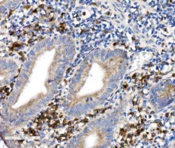 CD38 Antibody human appendicitis tissue IHC. Immunohistochemistry analysis of CD38 / plasma cell marker expression in FFPE human appendicitis tissue using a CD38 antibody. Strong membranous and cytoplasmic HRP-DAB brown staining highlights abundant plasma cells and activated lymphocytes within inflamed lamina propria and peri-glandular regions, with dense immune cell infiltration surrounding epithelial structures. The staining pattern demonstrates prominent immune activation associated with inflammatory pathology, while epithelial cells remain largely negative. HIER was performed by boiling tissue sections in pH 8 EDTA buffer for 20 minutes followed by cooling prior to antibody incubation.