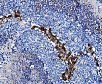 CD38 Antibody human lung cancer tissue IHC. Immunohistochemistry analysis of CD38 / plasma cell marker expression in FFPE human lung cancer tissue using a CD38 antibody. Strong membranous and cytoplasmic HRP-DAB brown staining highlights tumor-infiltrating plasma cells and activated lymphocytes within the tumor microenvironment, forming focal clusters along stromal and tumor interface regions. The staining pattern demonstrates immune cell infiltration associated with malignancy, while the majority of tumor cells remain negative. HIER was performed by boiling tissue sections in pH 8 EDTA buffer for 20 minutes followed by cooling prior to antibody incubation.