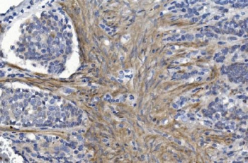 CRYAB Antibody Tumor Survival IHC. Immunohistochemistry of Alpha B crystallin / CRYAB in FFPE human gastric cancer tissue using polyclonal CRYAB antibody. HRP-DAB brown staining highlights cytoplasmic labeling in malignant cells and associated stromal components, with a distribution consistent with stress-adaptive and anti-apoptotic signaling within the tumor microenvironment, while nuclei are counterstained blue. Heat induced epitope retrieval was performed by boiling tissue sections in pH 8 EDTA for 20 min followed by cooling prior to staining.