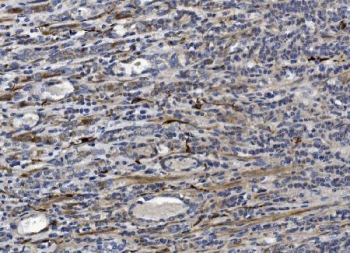 CRYAB Antibody Stromal Tumor IHC. Immunohistochemistry of Alpha B crystallin / CRYAB in FFPE human gastric cancer tissue using polyclonal CRYAB antibody. HRP-DAB brown staining highlights cytoplasmic labeling in spindle-shaped stromal cells and scattered tumor-associated cells, consistent with stress-response and survival signaling within the tumor microenvironment, while surrounding epithelial structures show comparatively lower staining and nuclei are counterstained blue. Heat induced epitope retrieval was performed by boiling tissue sections in pH 8 EDTA for 20 min followed by cooling prior to staining.