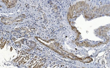 CRYAB Antibody Tumor Microenvironment IHC. Immunohistochemistry of Alpha B crystallin / CRYAB in FFPE human lung cancer tissue using polyclonal CRYAB antibody. HRP-DAB brown staining highlights cytoplasmic labeling in tumor-associated stromal cells and subsets of malignant epithelial cells, consistent with stress-adaptive and anti-apoptotic signaling within the tumor microenvironment, while adjacent non-neoplastic tissue shows reduced staining and nuclei are counterstained blue. Heat induced epitope retrieval was performed by boiling tissue sections in pH 8 EDTA for 20 min followed by cooling prior to staining.