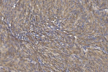 CRYAB Antibody Dermal Tumor IHC. Immunohistochemistry of Alpha B crystallin / CRYAB in FFPE human skin cancer tissue using polyclonal CRYAB antibody. HRP-DAB brown staining highlights diffuse cytoplasmic labeling in spindle-shaped tumor cells, consistent with stress-response and anti-apoptotic signaling in a mesenchymal-like tumor phenotype, while adjacent non-neoplastic epidermal regions show comparatively lower staining and nuclei are counterstained blue. Heat induced epitope retrieval was performed by boiling tissue sections in pH 8 EDTA for 20 min followed by cooling prior to staining.