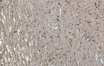 CRYAB Antibody Glioma Survival IHC. Immunohistochemistry of Alpha B crystallin / CRYAB in FFPE human glioma tissue using polyclonal CRYAB antibody. HRP-DAB brown staining highlights cytoplasmic labeling in tumor cells with a diffuse and heterogeneous distribution, consistent with stress-adaptive and anti-apoptotic signaling in neural-derived malignancy, while surrounding non-neoplastic elements show lower staining and nuclei are counterstained blue. Heat induced epitope retrieval was performed by boiling tissue sections in pH 8 EDTA for 20 min followed by cooling prior to staining.
