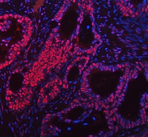 FOXP1 Antibody Human Intestinal Cancer IF. Immunofluorescent staining of paraffin-embedded human intestinal cancer tissue using FOXP1 Antibody / Forkhead Transcription Factor Antibody. Following heat-induced epitope retrieval in pH 8.0 EDTA buffer, the tissue was stained with FOXP1 antibody at 5 ug/ml and detected with a Fluoro550-conjugated secondary antibody (red), while nuclei were counterstained with DAPI (blue). Strong nuclear fluorescence is observed throughout the malignant epithelial cells, consistent with the expected localization of the FOXP1 transcription factor. This FOXP1 Antibody, a Forkhead Transcription Factor Antibody, is suitable for immunofluorescence studies of transcriptional regulation, intestinal cancer biology and tumor biomarker expression.