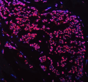 FOXP1 Antibody Human Breast Cancer IF. Immunofluorescent staining of paraffin-embedded human breast cancer tissue using FOXP1 Antibody / Forkhead Transcription Factor Antibody. Following heat-induced epitope retrieval in pH 8.0 EDTA buffer, the tissue was stained with FOXP1 antibody at 5 ug/ml and detected with a Fluoro550-conjugated secondary antibody (red), while nuclei were counterstained with DAPI (blue). Strong nuclear fluorescence is observed in tumor cells, consistent with the expected localization of the FOXP1 transcription factor. This FOXP1 Antibody, a Forkhead Transcription Factor Antibody, is suitable for immunofluorescence studies of transcriptional regulation, breast cancer biology and tumor biomarker expression.
