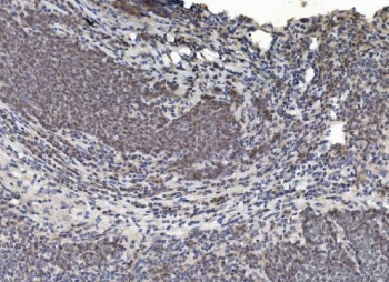 IHC staining of FFPE human lung cancer with HDAC5 antibody. HIER: boil tissue sections in pH8 EDTA for 20 min and allow to cool before testing.
