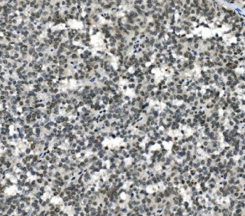 IHC staining of FFPE human melanoma with HOXD11 antibody. HIER: boil tissue sections in pH8 EDTA for 20 min and allow to cool before testing.