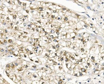 IHC staining of FFPE human liver cancer with SLC25A1 antibody. HIER: boil tissue sections in pH8 EDTA for 20 min and allow to cool before testing.