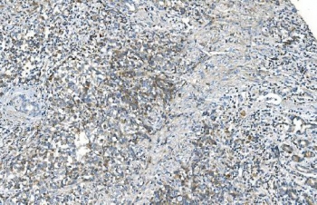 IHC staining of FFPE human gastric cancer with DR6 antibody. HIER: boil tissue sections in pH8 EDTA for 20 min and allow to cool before testing.