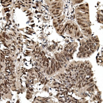 IHC staining of FFPE human rectal cancer with TRIM33 antibody. HIER: boil tissue sections in pH8 EDTA for 20 min and allow to cool before testing.