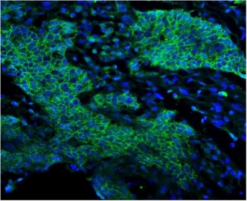 EGF Receptor Antibody for IF Lung Cancer Staining. Immunofluorescence analysis of FFPE human lung cancer tissue stained with EGF receptor antibody detecting EGFR (green). Tumor epithelial cells show strong membranous staining outlining cell borders with additional cytoplasmic signal, consistent with EGFR localization as a receptor tyrosine kinase and its trafficking following activation. The staining highlights malignant epithelial structures within the tumor microenvironment, while surrounding stromal areas show comparatively lower signal. DAPI nuclear stain (blue) highlights nuclei. HIER: boil tissue sections in pH 8 EDTA for 20 min and allow to cool before testing.
