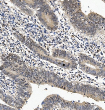 IHC staining of FFPE human rectal cancer with EYA4 antibody. HIER: boil tissue sections in pH8 EDTA for 20 min and allow to cool before testing.