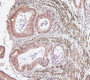 IRF3 Antibody Rectal Cancer IHC. Immunohistochemistry staining of FFPE human rectal cancer with IRF3 antibody. HIER: boil tissue sections in pH8 EDTA for 20 min and allow to cool before testing.