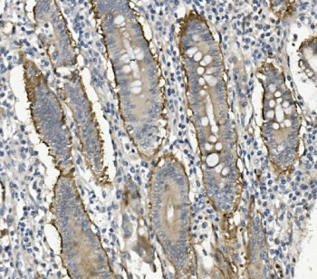 IHC staining of FFPE human rectal cancer with ITGB4 antibody. HIER: boil tissue sections in pH8 EDTA for 20 min and allow to cool before testing.