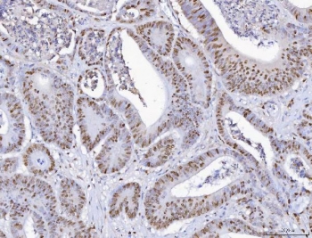 IHC staining of FFPE human intestinal cancer with MCM6 antibody. HIER: boil tissue sections in pH8 EDTA for 20 min and allow to cool before testing.