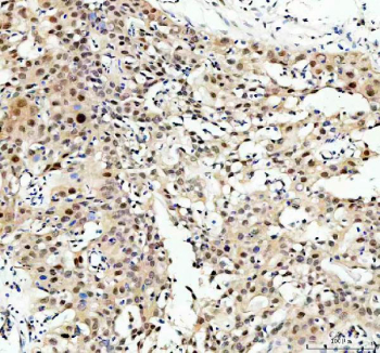 IHC staining of FFPE human bladder cancer tissue with NFAT5 antibody. HIER: boil tissue sections in pH8 EDTA for 20 min and allow to cool before testing.