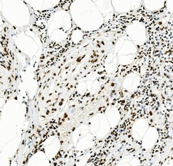 IHC staining of FFPE human rectal cancer with TRIM28 antibody. HIER: boil tissue sections in pH8 EDTA for 20 min and allow to cool before testing.