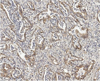 IHC staining of FFPE human rectal cancer with MMUT antibody. HIER: boil tissue sections in pH8 EDTA for 20 min and allow to cool before testing.
