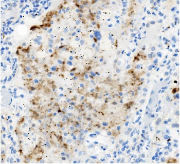 IHC staining of FFPE human lung cancer with ATG4A antibody. HIER: boil tissue sections in pH8 EDTA for 20 min and allow to cool before testing.