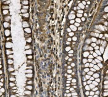 IHC staining of FFPE human thyroid cancer with BCAM antibody. HIER: boil tissue sections in pH8 EDTA for 20 min and allow to cool before testing.