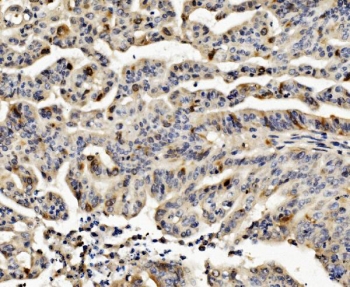 IHC staining of FFPE human rectal cancer with CCNB1 antibody. HIER: boil tissue sections in pH8 EDTA for 20 min and allow to cool before testing.