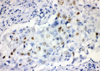 CCNE1 Antibody Lung Cancer IHC. Immunohistochemistry staining of FFPE human lung cancer with CCNE1 antibody. HIER: boil tissue sections in pH8 EDTA for 20 min and allow to cool before testing.