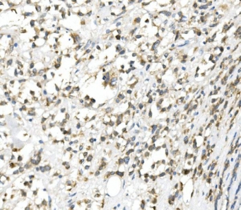 IHC staining of FFPE human B lymphocytic tumor tissue with CHOP antibody. HIER: boil tissue sections in pH8 EDTA for 20 min and allow to cool before testing.