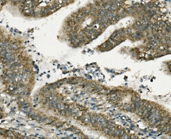 Gastrotropin Antibody Rectal Cancer IHC. Immunohistochemical staining of FFPE human rectal cancer demonstrates Gastrotropin expression using a Gastrotropin antibody. Gastrotropin, also known as Intestinal Lipid Binding Protein and FABP6, is an intracellular Bile Acid Binding Protein that mediates bile acid trafficking and contributes to lipid homeostasis. Prominent cytoplasmic and membranous staining is observed in malignant glandular epithelial cells, consistent with altered nutrient utilization and bile acid signaling associated with colorectal tumor progression. Heat induced epitope retrieval was performed by boiling tissue sections in pH 8 EDTA buffer for 20 minutes followed by cooling prior to staining. These results support the utility of Gastrotropin Antibody for studies of bile acid transport, metabolic regulation, gastrointestinal physiology, and cancer biology.