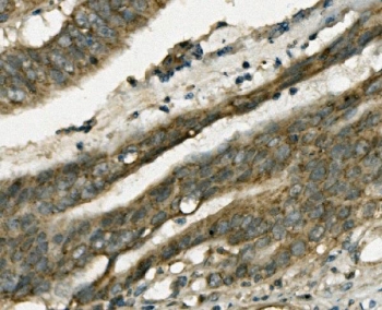 Gastrotropin Antibody Rectal Adenocarcinoma IHC. Immunohistochemical staining of FFPE human rectal cancer demonstrates expression of Gastrotropin using a Gastrotropin antibody. Gastrotropin, also known as Intestinal Lipid Binding Protein and FABP6, is a Bile Acid Binding Protein involved in intracellular bile acid trafficking and maintenance of lipid homeostasis. Diffuse cytoplasmic staining with focal membranous accentuation is observed throughout neoplastic glands, consistent with enhanced metabolic activity and altered bile acid signaling in colorectal malignancies. Heat induced epitope retrieval was performed by boiling tissue sections in pH 8 EDTA buffer for 20 minutes followed by cooling prior to staining. These findings support the use of Gastrotropin Antibody for investigations of gastrointestinal physiology, nutrient transport, and cancer metabolism.
