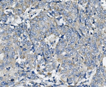 IHC staining of FFPE human lung cancer with TTC11 antibody. HIER: boil tissue sections in pH8 EDTA for 20 min and allow to cool before testing.