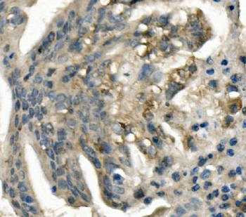 Immunohistochemistry analysis of LDL Receptor Antibody in human rectal cancer tissue. FFPE human rectal carcinoma demonstrates cytoplasmic and membranous HRP-DAB brown staining in tumor epithelial cells, consistent with LDL receptor (LDLR) expression involved in lipid uptake and metabolic activity, while surrounding stromal cells show lower staining intensity. Antigen retrieval was performed by boiling tissue sections in EDTA buffer, pH 8.0, for 20 minutes followed by cooling prior to incubation with LDL Receptor antibody.