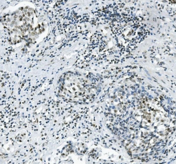 IHC staining of FFPE human gastric cancer with PRDM5 antibody. HIER: boil tissue sections in pH8 EDTA for 20 min and allow to cool before testing.