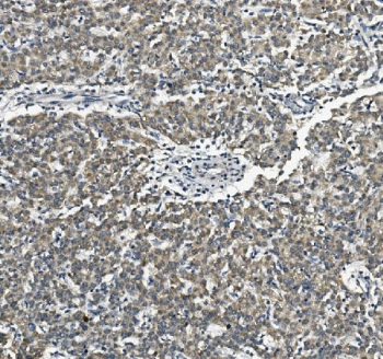IHC staining of FFPE liver cancer with Vinexin antibody. HIER: boil tissue sections in pH8 EDTA for 20 min and allow to cool before testing.
