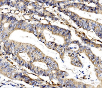 MC4-R Antibody Human Rectal Cancer IHC. Immunohistochemistry staining of FFPE human rectal cancer tissue using MC4-R antibody demonstrates moderate cytoplasmic and membranous staining within malignant gland-forming epithelial cells, consistent with expression of Melanocortin Receptor 4 (MC4-R). MC4-R is a G protein-coupled receptor that mediates melanocortin signaling pathways involved in energy homeostasis, neuroendocrine communication, and metabolic regulation. The observed staining pattern is consistent with the expected localization of a membrane-associated receptor and supports the utility of MC4-R antibody for studies of receptor-mediated signaling, endocrine regulation, and melanocortin pathway biology. HIER: boil tissue sections in pH8 EDTA for 20 min and allow to cool before testing.