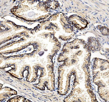 Immunohistochemical staining using NDRG1 antibody on paraffin-embedded human prostate cancer tissue sections. Heat-induced epitope retrieval was performed using EDTA buffer (pH 8.0) prior to antibody incubation. Sections were blocked with 10% goat serum and incubated with rabbit anti-NDRG1 antibody at 2 micrograms per milliliter overnight at 4C. Detection was carried out using a peroxidase-conjugated goat anti-rabbit IgG secondary antibody and DAB as the chromogen. Nuclei were counterstained with hematoxylin.