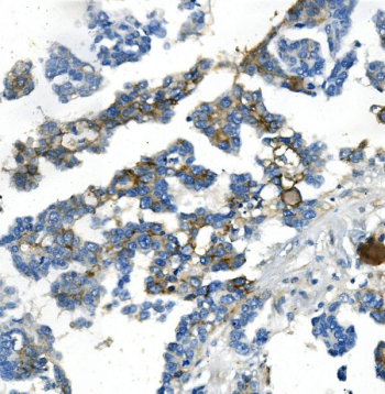 Immunohistochemical staining using NDRG1 antibody on paraffin-embedded human ovarian cancer tissue sections. Heat-induced epitope retrieval was performed using EDTA buffer (pH 8.0) prior to antibody incubation. Sections were blocked with 10% goat serum and incubated with rabbit anti-NDRG1 antibody at 2 micrograms per milliliter overnight at 4C. Detection was carried out using a peroxidase-conjugated goat anti-rabbit IgG secondary antibody and DAB as the chromogen. Nuclei were counterstained with hematoxylin.