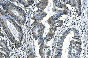 IHC staining of FFPE human rectal cancer with SLBP/Stem-Loop Binding Protein antibody. HIER: boil tissue sections in pH8 EDTA for 20 min and allow to cool before testing.