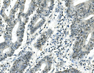 ATF1 Antibody Human Rectal Cancer Tissue IHC. Immunohistochemical analysis of ATF1 Antibody / Activating Transcription Factor 1 Antibody in FFPE human rectal cancer tissue following heat-induced antigen retrieval in pH 8 EDTA buffer. The section was incubated with ATF1 antibody at 1 ug/ml and detected using a biotinylated secondary antibody with streptavidin-biotin complex and DAB chromogen. Positive nuclear staining is observed in rectal cancer cells, consistent with the transcriptional activity of ATF1. This ATF1 Antibody, an Activating Transcription Factor 1 antibody, is suitable for investigating transcriptional regulation, cellular signaling and cancer biology.
