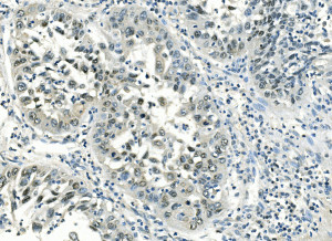 ATF1 Antibody Human Lung Cancer IHC. Immunohistochemical analysis of ATF1 Antibody / Activating Transcription Factor 1 Antibody in FFPE human lung cancer tissue following heat-induced antigen retrieval in pH 8 EDTA buffer. The section was incubated with ATF1 antibody at 1 ug/ml and detected using a biotinylated secondary antibody with streptavidin-biotin complex and DAB chromogen. Positive nuclear staining is observed in lung cancer cells, consistent with the transcriptional activity of ATF1. This ATF1 Antibody, an Activating Transcription Factor 1 antibody, is suitable for investigating transcriptional regulation, cellular signaling and cancer biology.