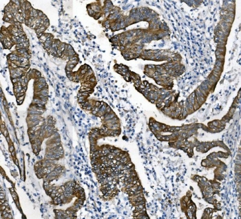 IHC staining of FFPE human rectal cancer with Keratin 18 antibody. HIER: boil tissue sections in pH8 EDTA for 20 min and allow to cool before testing.