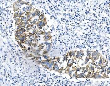 IHC staining of FFPE human lung cancer with Keratin 18 antibody. HIER: boil tissue sections in pH8 EDTA for 20 min and allow to cool before testing.