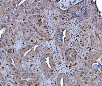 IHC staining of FFPE human gallbladder adenocarcinoma with MCM4 antibody. HIER: boil tissue sections in pH8 EDTA for 20 min and allow to cool before testing.