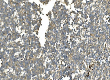 IHC staining of FFPE human melanoma with CA13 antibody. HIER: boil tissue sections in pH8 EDTA for 20 min and allow to cool before testing.