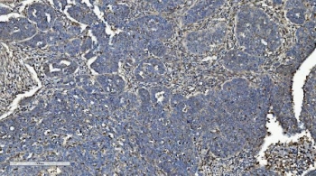 IHC staining of FFPE human adnexal serous adenocarcinoma tissue with CMBL antibody. HIER: boil tissue sections in pH8 EDTA for 20 min and allow to cool before testing.