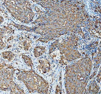 Immunohistochemical staining of FFPE human invasive adenocarcinoma of the lung tissue with Mucin 1 antibody, HRP-secondary and DAB substrate. HIER: boil tissue sections in pH8 EDTA for 20 min and allow to cool before testing.