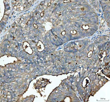 Immunohistochemical staining of FFPE human endometrioid adenocarcinoma tissue with Mucin 1 antibody, HRP-secondary and DAB substrate. HIER: boil tissue sections in pH8 EDTA for 20 min and allow to cool before testing.