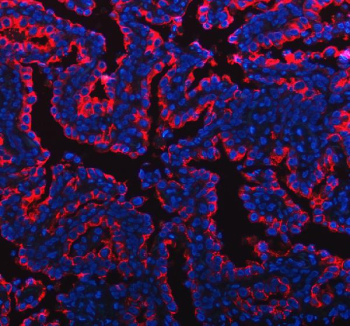 Immunofluorescent staining of FFPE human lung adenocarcinoma tissue with Mucin 1 antibody (red) and DAPI nuclear stain (blue). HIER: steam section in pH8 EDTA buffer for 20 min.