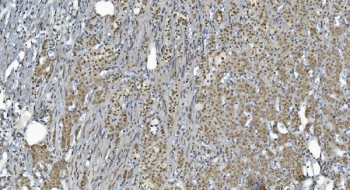 IHC staining of FFPE human renal carcinoma with GLRX2 antibody. HIER: boil tissue sections in pH8 EDTA for 20 min and allow to cool before testing.