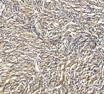 GRID2 Antibody Glioma Tissue IHC. Immunohistochemistry staining of FFPE human glioma tissue with GRID2 antibody. HIER: boil tissue sections in pH8 EDTA for 20 min and allow to cool before testing.