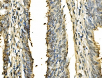 IHC staining of FFPE human rectal cancer with PSME2 antibody. HIER: boil tissue sections in pH8 EDTA for 20 min and allow to cool before testing.